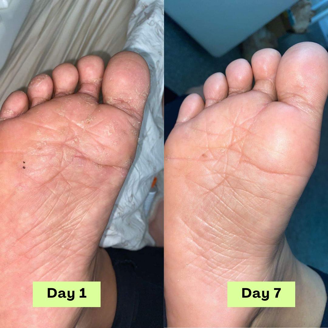 💫Limited-time offer: 💪55% off NESLEMY® AntiFungal Relief Soap Bar💫