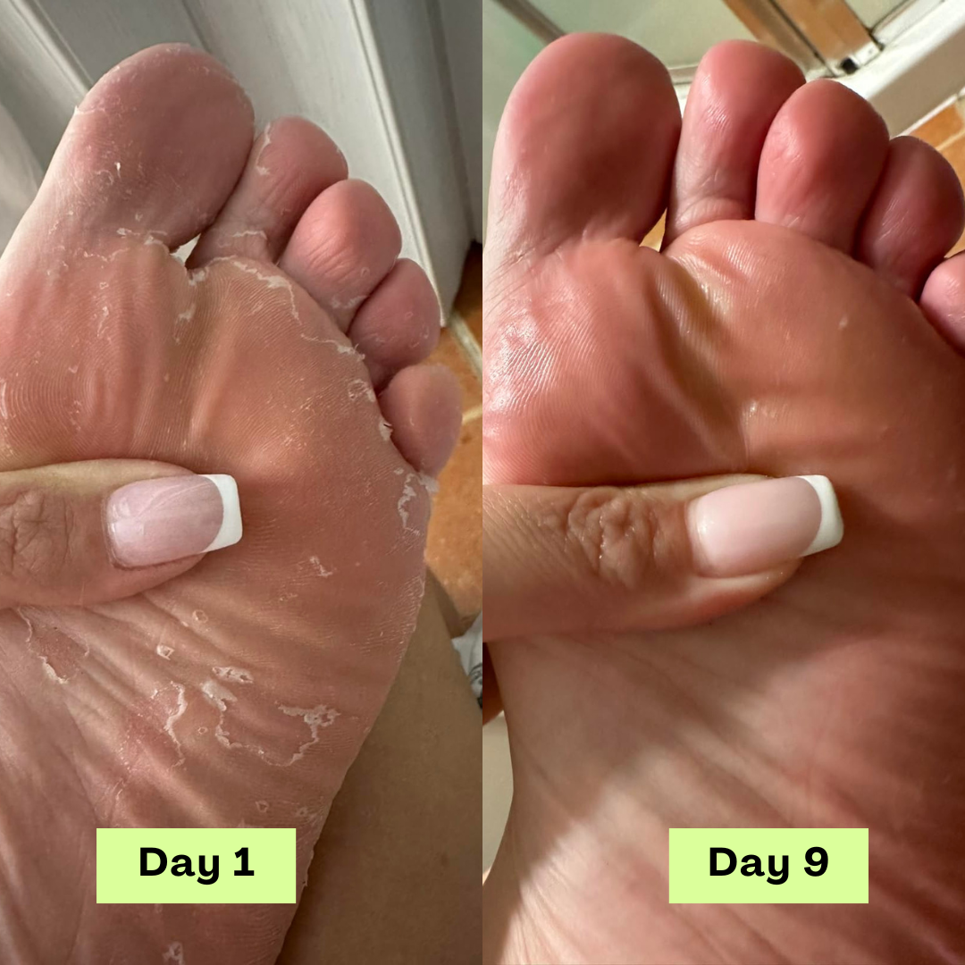 💫Limited-time offer: 💪55% off NESLEMY® AntiFungal Relief Soap Bar💫