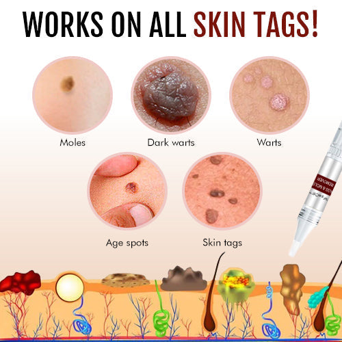 🎁🎁BUY 2 GET 1 FREE🎁LOVILDS™ Tags & Moles Remover